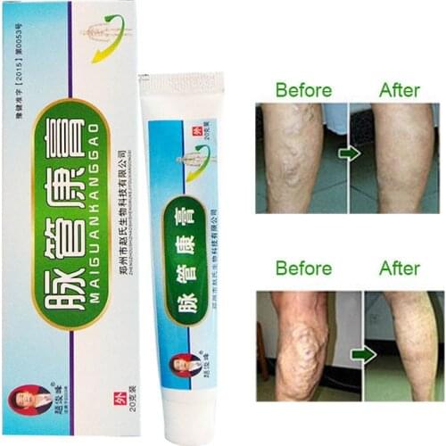 Hot Sale Natural Herbal Varicose Vein Massage Cream for Treating Varicose Vascular Dropshipping
