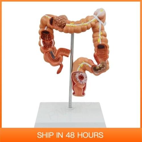 Human Digestive System Organ Anatomy Diseased Large Intestines PNT-07451 Medical Supplies and Equipment Anatomical Model