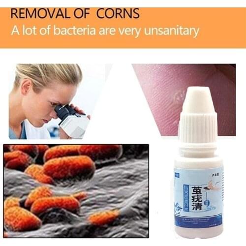 10ml*10pcs Genital Warts Treatment Papilloma Removal Makeup Removal For Moles The Skin On Liquid Of Anti-Remedy Remover War O0N4