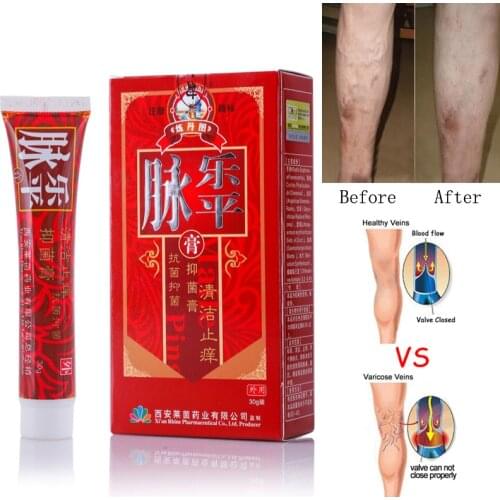 Varicose Veins Treatment Cream Ointment Vasculitis Phlebitis Spider Veins Pain Varicosity Angiitis Remedy Removal Herbal Cream