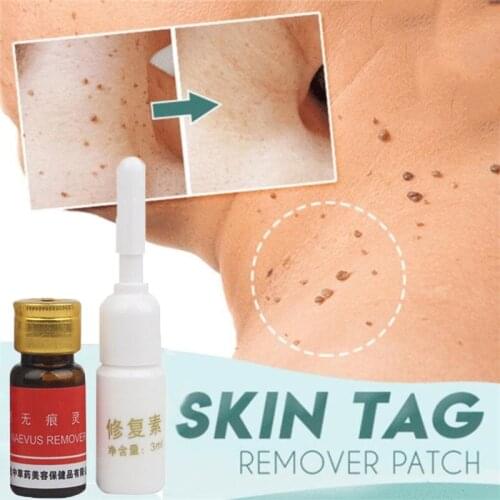 Orignal Chinese Medication Speckle Freckle Moles Wart Remove Water Speckle Freckle Seamless Water Drops Skin Tags Removal Cream