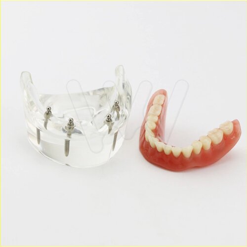 1Pc Dental Teeth Study Model Overdenture Inferior 4 Implant Demo Model