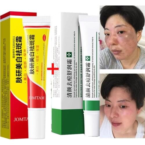 Whitening Freckle Cream Remove Melasma +Acne Treatment Fade Acne Spots Oil Control Shrink Pore Moisturizing Acne Cream Skin Care