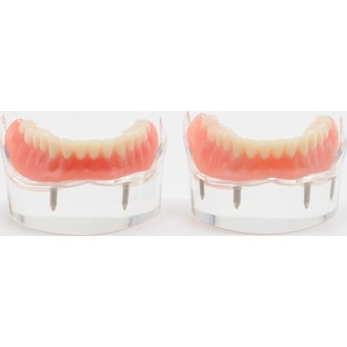 Dental Lab Lower Mandibular With 2/4 Implants Restoration Teach Model For Dentistry Clinic Item