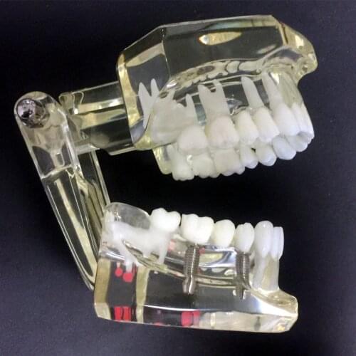 Dental Implant Disease Teeth Model With Restoration Bridge Malocclusion Orthodontic Model For Medical Science Dental Research