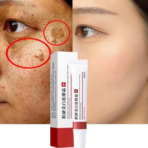 Whitening Freckle Cream Remove Melasma Cream Remove Dark Spots Melanin Melasma Remover Brighten Skin Anti-Aging Skin Lightening