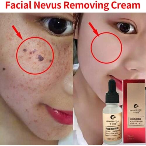 Dark Spot Home Solution Painless No Harm Foot Corn Skin Tag Remover Serum Wart Professional Liquid Mole Portable Freckle 20ml