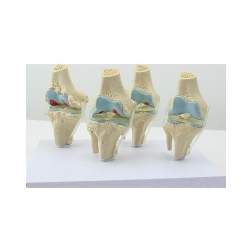 Human Morbid state Knee Joint model Human Skeleton Osteoporosis model free shipping