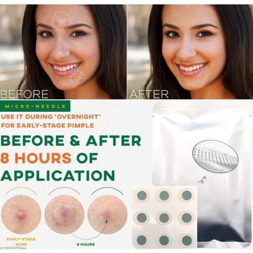 9 Patches Microneedle Acne Pimple Healing Patch Acne Pimple Patch Invisible Acne Stickers Blemish Treatment Acne Master Pimple