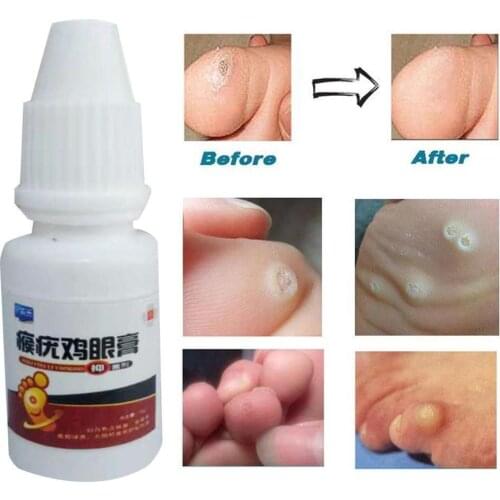 Skin Tag Remover 12 hours Medical Remover Against Skin Tag Mole Wart Corns Wart corns ointment Pedicure knife
