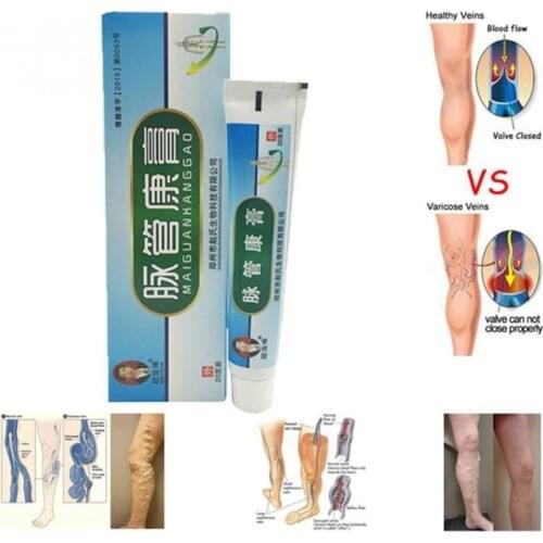 Varicose Veins ointment vasculitis treatment Phlebitis Angiitis inflammation blood vessel Rotten legs Varicose Veins Cream