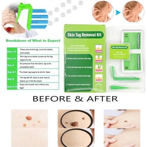 Small To Medium Face Care Skin Mole Tag Wart Remover Kit Non Toxic Green Micro Band Skin Tag Removal Kit Mole Wart 2-4mm 4-6mm