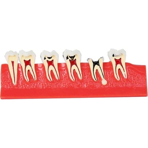 Oral Pathological Tooth Model /Dental Caries illustration Model M4011/Oral Teaching Model