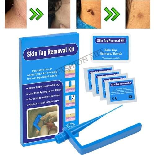 For Small To Medium Face Care Blue Tool Corn With Cleansing Swabs Mole Wart Home Use Micro Band Non Toxic Skin Tag Removal Kit