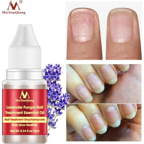 Lavender Fungal Nail Treatment Essential Oil Onychomycosis Paronychia Anti-Fungal Herbal Toe Fungus Foot Repair Essence Care
