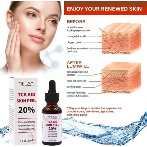 30ml Tca Aid Skin Peel Trichloroaectic Acid 20% Skin Skin Pore Face Peel Care Minizing Spots Wrinkles Serum G9Z5