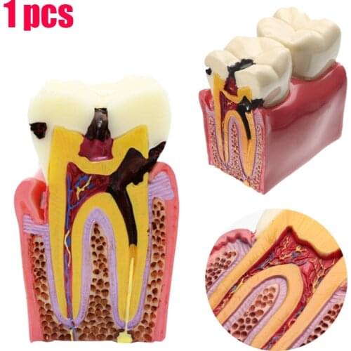 1 pcs Dental Anatomy Education Teeth Model 6 Times Caries Comparation Study Models For Dentist Studying and Researching