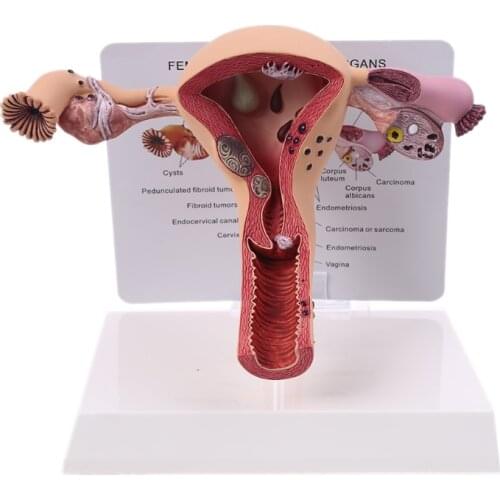 Biology Teaching, Anatomy Lesion Uterus Model, Human Female Uterus Ovary Disease Dissection Pathology Model