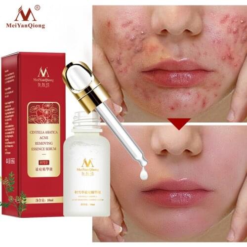 MeiYanQiong Acne Removing Essence Face Serum Liquid Control Oil Moisturizing Acne Treatment Shrink Pore Face Cream 10ml
