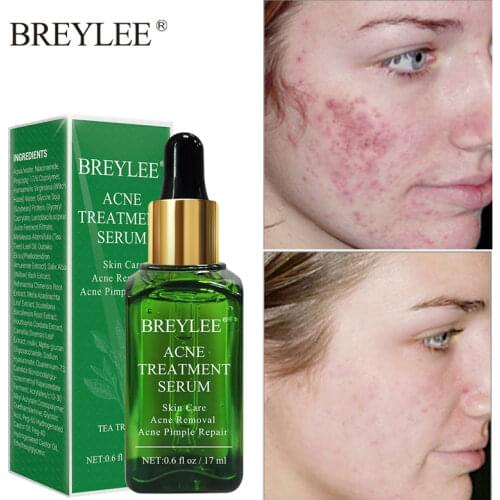 BREYLEE Acne Treatment Face Serum Anti Acne Pimple Scar Remover Repair Moisturizing Whitening Face Facial Essence Skin Care