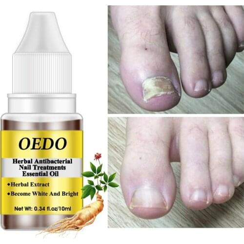 Antibacterial Nail Treatment Essential Oil Herbal Extract Nail Fungus Repair Tools Toenail Care