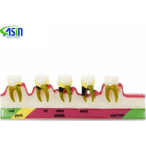 Dental Periodontal Disease assort Teeth Dentoform Typodont Study Teaching Model